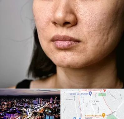 سابسیژن جای جوش در گلسار رشت 