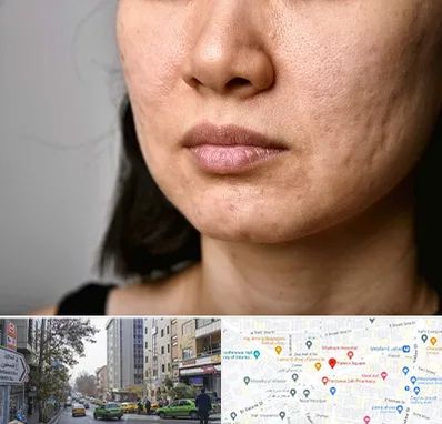 سابسیژن جای جوش در فاطمی 