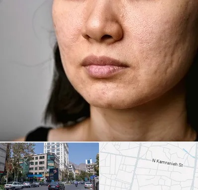سابسیژن جای جوش در کامرانیه