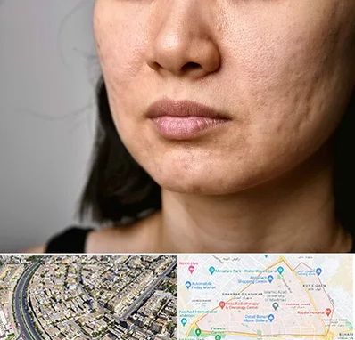 سابسیژن جای جوش در شهرک غرب مشهد