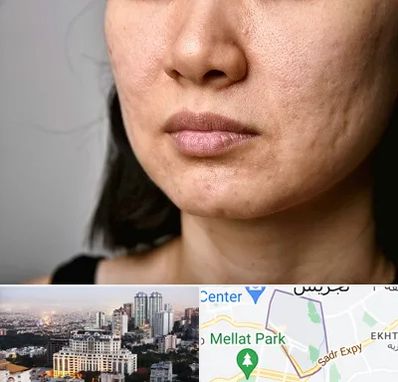 سابسیژن جای جوش در الهیه 