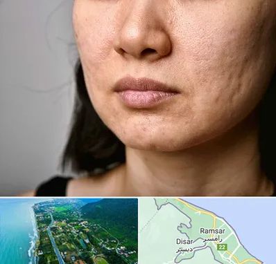 سابسیژن جای جوش در رامسر