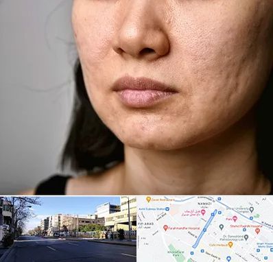 سابسیژن جای جوش در خیابان ملاصدرا شیراز