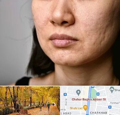 سابسیژن جای جوش در چهارباغ اصفهان