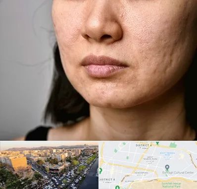 سابسیژن جای جوش در تهرانپارس 