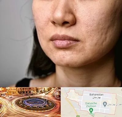 سابسیژن جای جوش در بهارستان