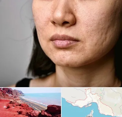 سابسیژن جای جوش در هرمزگان