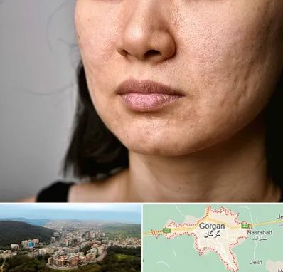 سابسیژن جای جوش در گرگان