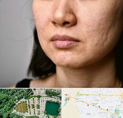 سابسیژن جای جوش در وکیل آباد مشهد