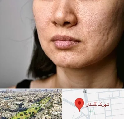 سابسیژن جای جوش در شهرک گلستان