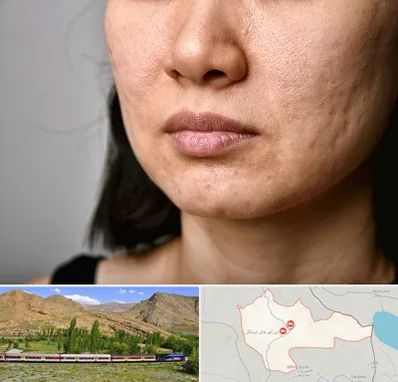 سابسیژن جای جوش در خاش