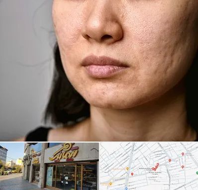 سابسیژن جای جوش در عطاران قم