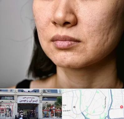 سابسیژن جای جوش در ایران زمین