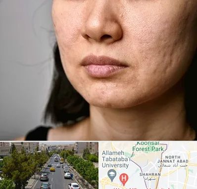 سابسیژن جای جوش در شهران 