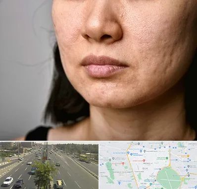 سابسیژن جای جوش در منطقه 17 تهران 