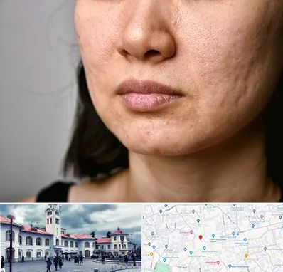 سابسیژن جای جوش در میدان شهرداری رشت