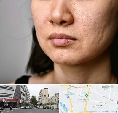 سابسیژن جای جوش در بلوار فردوس 