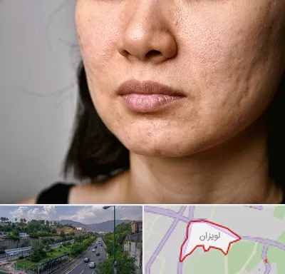 سابسیژن جای جوش در لویزان