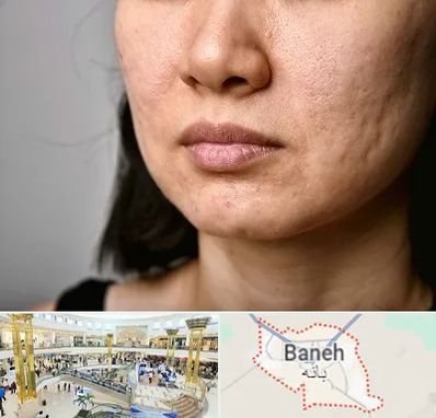 سابسیژن جای جوش در بانه