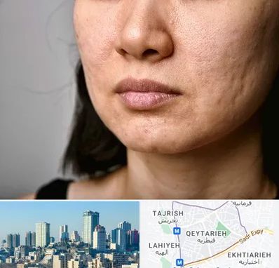 سابسیژن جای جوش در قیطریه 