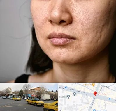 سابسیژن جای جوش در شهناز تبریز