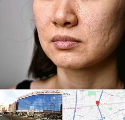 سابسیژن جای جوش در نصف راه تبریز