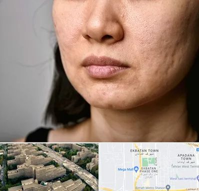 سابسیژن جای جوش در اکباتان 