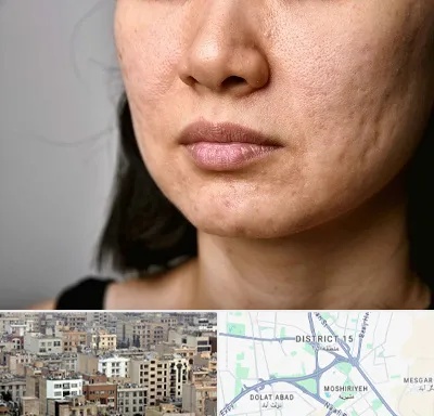 سابسیژن جای جوش در جنوب شرق تهران