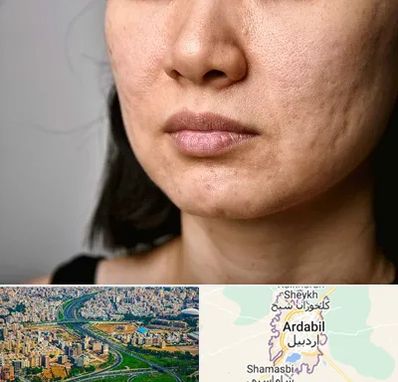 سابسیژن جای جوش در اردبیل