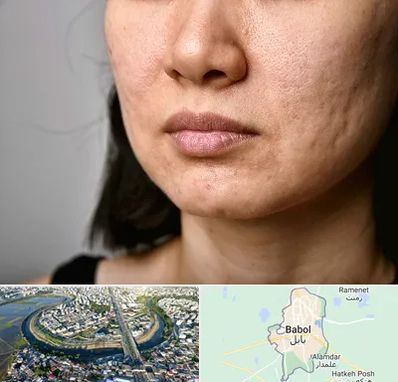 سابسیژن جای جوش در بابل