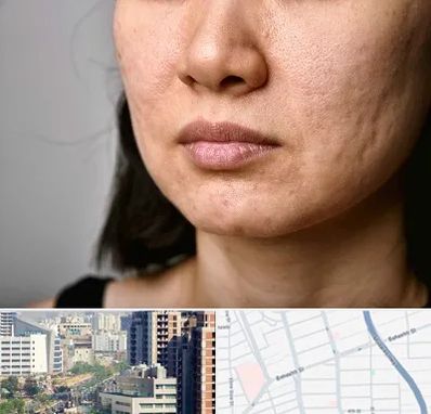 سابسیژن جای جوش در خیابان بهشتی