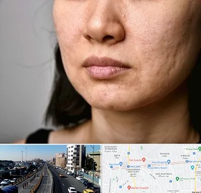 سابسیژن جای جوش در پیروزی 