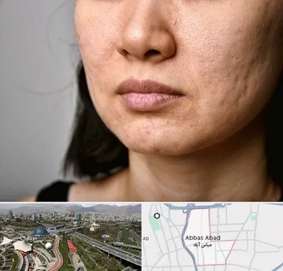 سابسیژن جای جوش در عباس آباد تهران