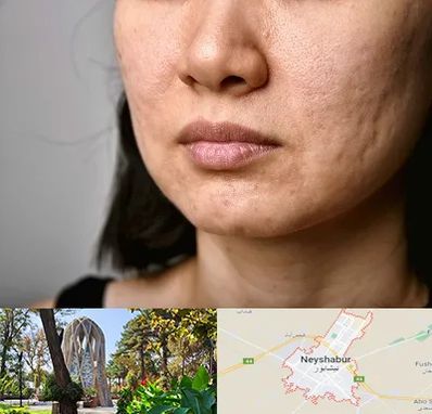 سابسیژن جای جوش در نیشابور