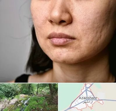 سابسیژن جای جوش در آزادشهر