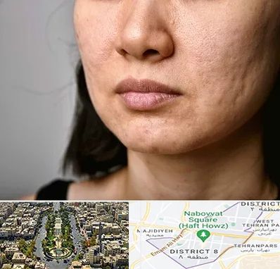 سابسیژن جای جوش در نارمک 