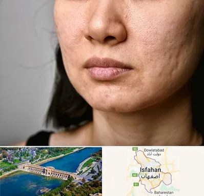 سابسیژن جای جوش در اصفهان