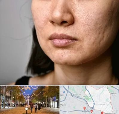 سابسیژن جای جوش در ولیعصر ارومیه