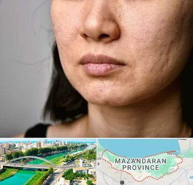سابسیژن جای جوش در مازندران