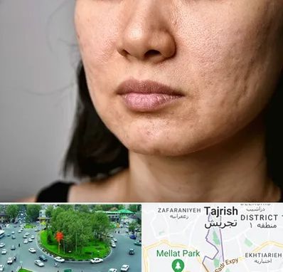 سابسیژن جای جوش در تجریش 