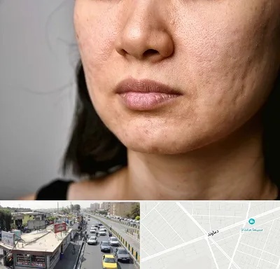 سابسیژن جای جوش در خیابان دماوند