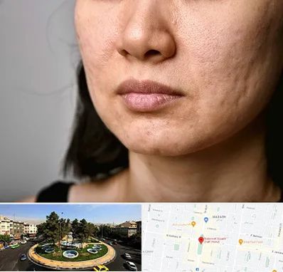 سابسیژن جای جوش در هفت حوض 