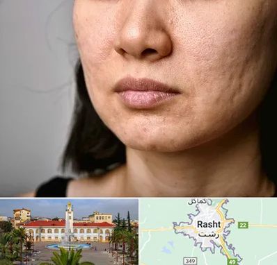 سابسیژن جای جوش در رشت