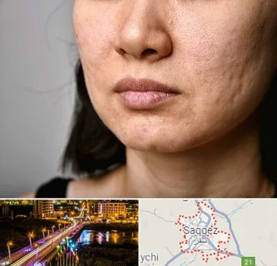 سابسیژن جای جوش در سقز