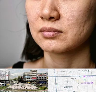 سابسیژن جای جوش در مرکز تهران