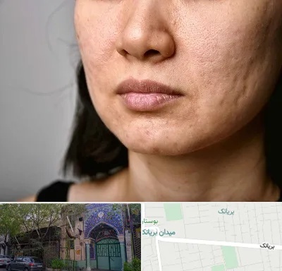 سابسیژن جای جوش در بریانک