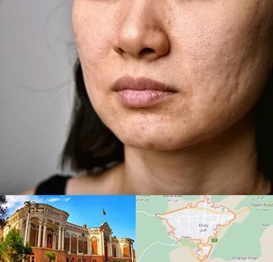 سابسیژن جای جوش در خوی