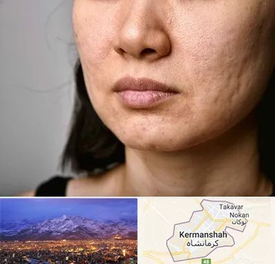 سابسیژن جای جوش در کرمانشاه