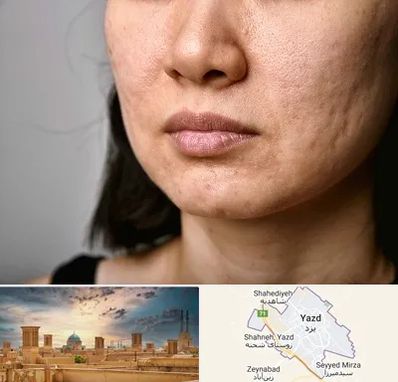 سابسیژن جای جوش در یزد