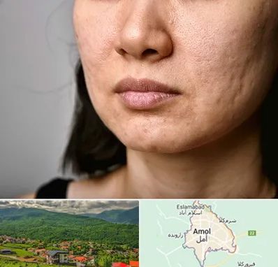 سابسیژن جای جوش در آمل